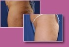 Aspen Combi Lipo, vorher und nachher, Fall 1