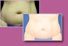 Aspen Combi Lipo, vorher und nachher, Fall 3