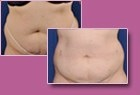 Aspen Combi Lipo, vorher und nachher, Fall 6