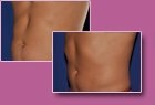 Aspen Combi Lipo, vorher und nachher, Fall 8